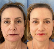 Nanofiber Collagen Mask: Clinically Proven Hydration & Wrinkle Reduction beauty