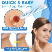 Auto tag removal kit - remove skin tags Beauty