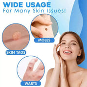 Auto tag removal kit - remove skin tags Beauty