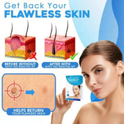 Auto tag removal kit - remove skin tags Beauty