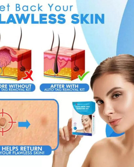 Auto tag removal kit - remove skin tags Beauty