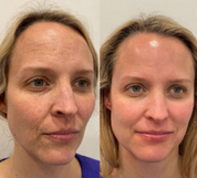 Nanofiber Collagen Mask: Clinically Proven Hydration & Wrinkle Reduction beauty