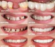 White Smile Easy Click Instant Denture Denture
