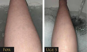 IPL - Permanent hair removal beauty