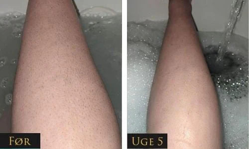 IPL - Permanent hair removal beauty