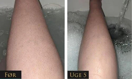 IPL - Permanent hair removal beauty
