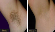 IPL - Permanent hair removal beauty
