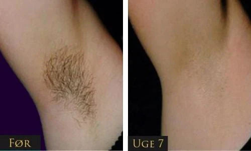 IPL - Permanent hair removal beauty