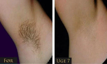 IPL - Permanent hair removal beauty