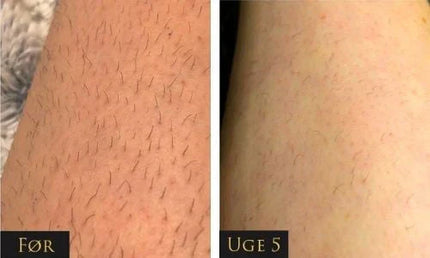 IPL - Permanent hair removal beauty