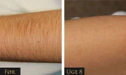 IPL - Permanent hair removal beauty