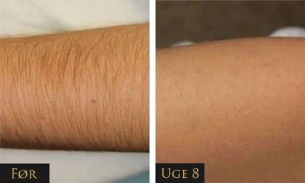 IPL - Permanent hair removal beauty