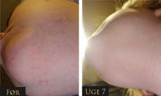 IPL - Permanent hair removal beauty