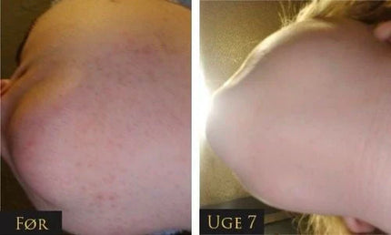 IPL - Permanent hair removal beauty